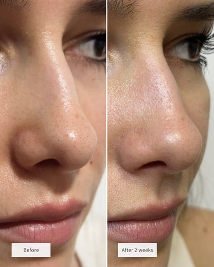 🔥💞LAST DAY 75% OFF ✨✨🧄Deep-Clean Nose Strips – Removes Blackheads & Tightens Pores