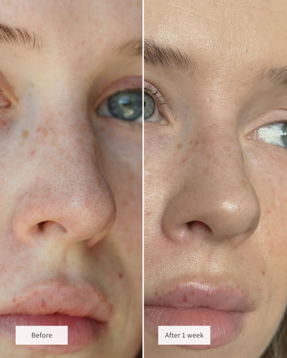 🔥💞LAST DAY 75% OFF ✨✨🧄Deep-Clean Nose Strips – Removes Blackheads & Tightens Pores
