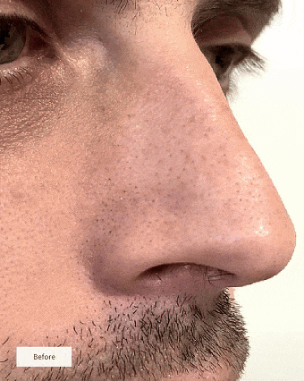 🔥💞LAST DAY 75% OFF ✨✨🧄Deep-Clean Nose Strips – Removes Blackheads & Tightens Pores